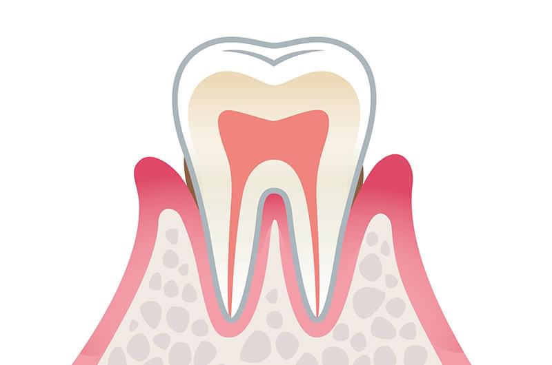 歯肉炎（軽度）